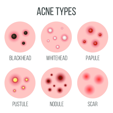 Welche Akne-Formen gibt es?