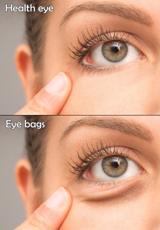 Ursachen von Augenringen