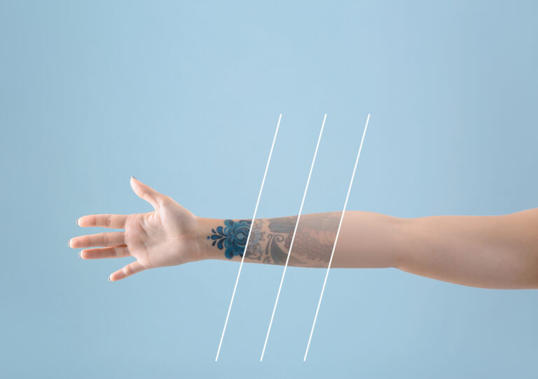Die Laser-Tattooentfernung - wie Sie Ihr altes Tattoo effizient entfernen lassen